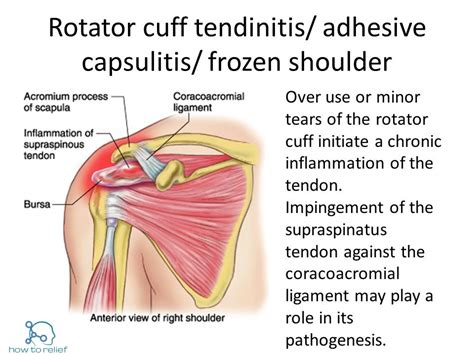 Supraspinatus Muscle Shoulder Arm Pain Frozen Shoulder Rotator Cuff My Xxx Hot Girl