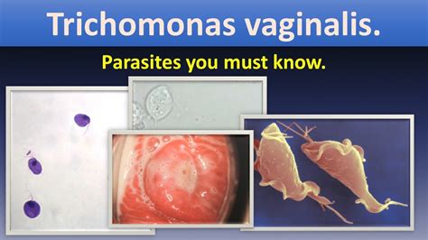 Trichomonas Vaginalis Life Cycle Lab Diagnosis Infection