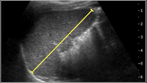 Normal Spleen Measurement Ultrasound