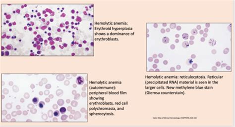 Hemolytic Anemias Hereditary Spherocytosis G6pd Deficiency Sickle