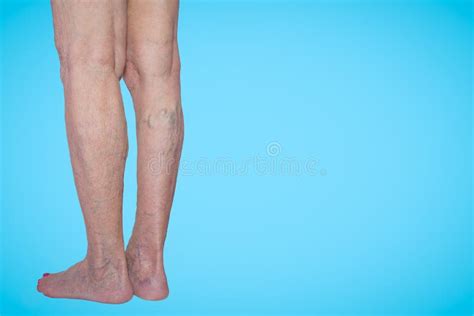 Varicose Veins On A Female Legs Stock Photo Image Of Elderly Chronic