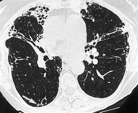 Pulmonary Nontuberculous Mycobacterial Infection Radiologic