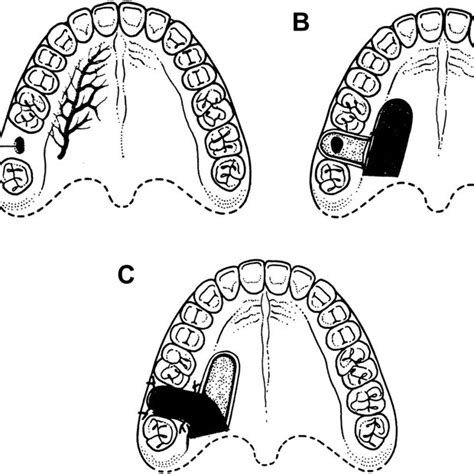 A Incision Of The Flap B Palatal Flap Under Mucosal Bridge Source