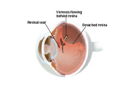 How to treat retinal tears with laser.in this episode we're looking at everything you need to know about. Detached and Torn Retina