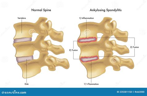 Ankylosing Spondylitis Medical Illustration Stock Vector Illustration