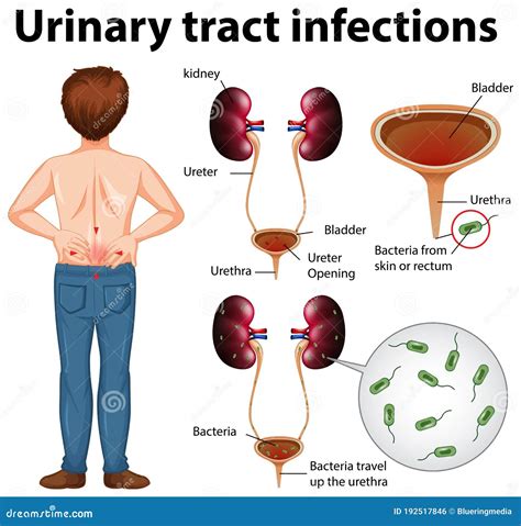 Informative Illustration Of Urinary Tract Infections Stock Vector Illustration Of Medicine