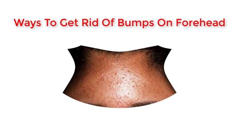 How To Get Rid Of A Bump On Forehead Overnight Get Rid Of Bumps