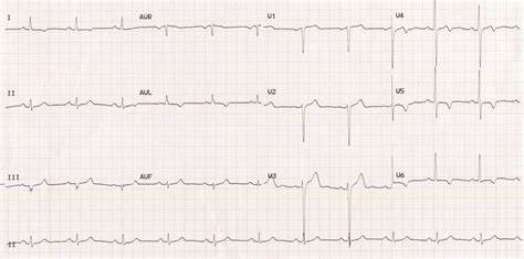 Lateral Wall Ischemia And Lvh All About Cardiovascular System And