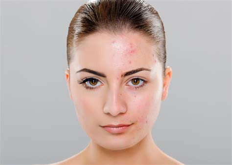 Acne Information An In Depth Study Skindoc Liverpool Dermatologist