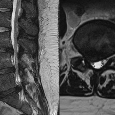 Mri Showing Lumbar Disc Herniation On L5 S1 Disc With Neural