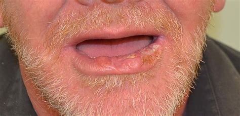 Lip Basal Cell Carcinoma Pictures
