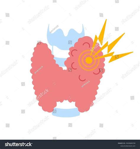 Goitre Disease Over 106 Royalty Free Licensable Stock Vectors And Vector