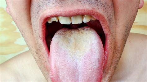 Symptoms Of Oral Candidiasis Factory Price Save 54 Jlcatjgobmx