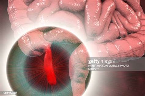 Appendicitis Photos And Premium High Res Pictures Getty Images