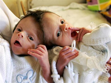 Conjoined Twins Amazing Photos Graphic Images Photo