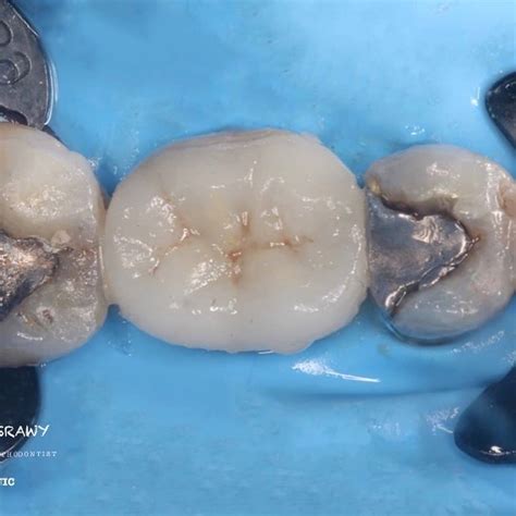 Saving Mission Of Fractured Molar Myzerodonto