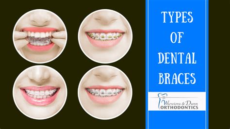 Which Type Of Braces Is Right For You Wiewiora And Dunn Orthodontics