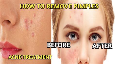 How To Remove Pimples Completely Youtube