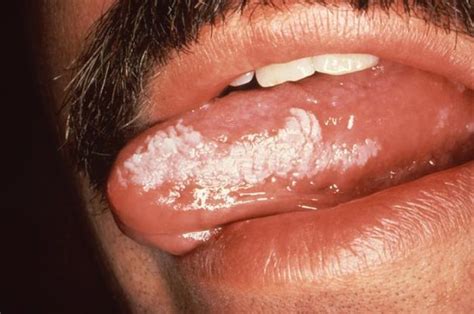 Hyperkeratosis Leukoplakia Reduce Risk Of Oral Cancer