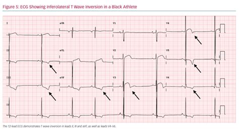 Ecg Showing Inferolateral T Wave Inversion In A Black Athlete