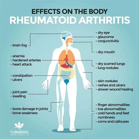 Rheumatoid Arthritis And Cancer Whats The Connection