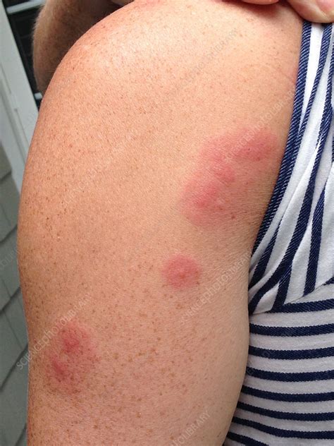 Is My Babys Itchiness Caused By Bed Bugs Bedbugs