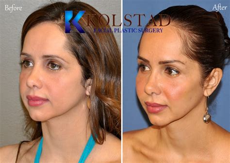 The Heart Shaped Cheek Dr Kolstad San Diego Facial Plastic Surgeon
