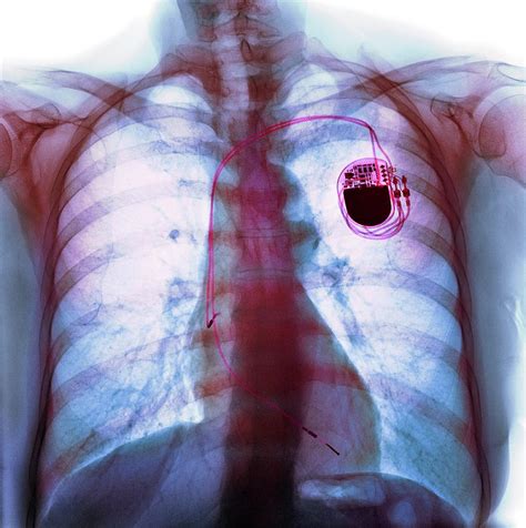 Dual Chamber Pacemaker Photograph By Science Photo Library Pixels Merch