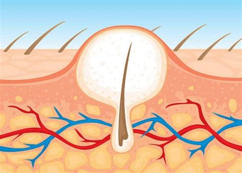 Ingrown Hair On Scalp Head With Cyst Bump Causes And Removal Treat