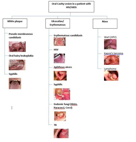 Oral Cavity Lesions In A Patient With Hivaids White Grepmed