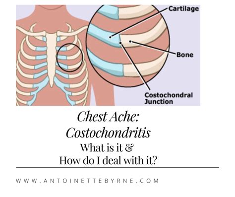 Chest Pain And Costochondritis Antoinette Byrne