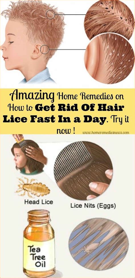 How To Get Rid Of Head Lice In One Day Head Louse Hair Lice Lice