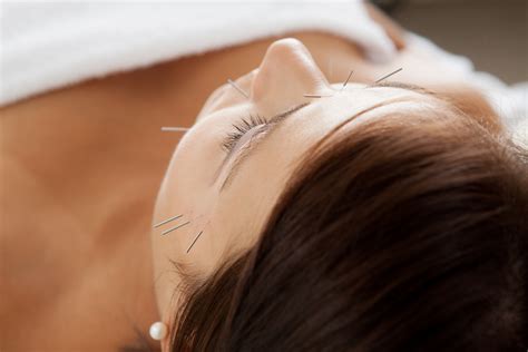 Facial Acupuncture Hammersmith West London | Cosmetic Acupuncture W4