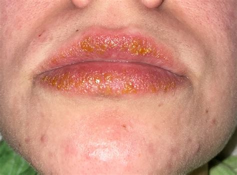 Lip Eczema Please Help Reczema