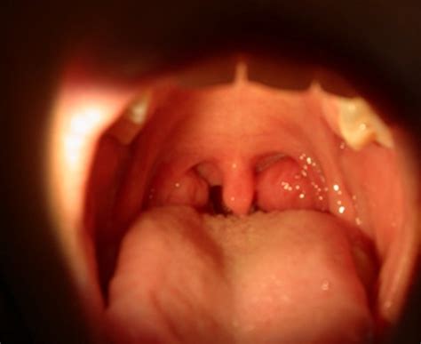 Tonsil cancer is a type of oral cancer, and human papillomavirus infection puts patients at a greater risk. What is Tonsil Cancer? Causes and Pictures