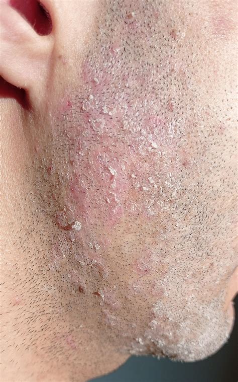 Skin On My Face Is Peeling Had It For 5 Years Rdermatologyquestions