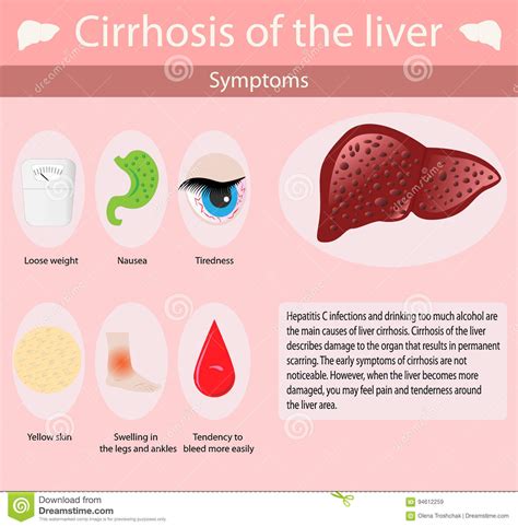 Cirrhosis is characterized by the formation of regenerative nodules in liver parenchyma surrounded by fibrous septa due to chronic liver injury. Symptoms Of Cirrhosis Oh The Liver. Stock Vector ...