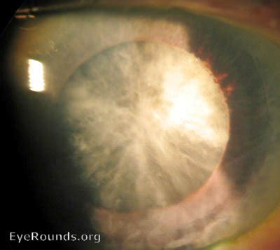 Mature Cataract Eyerounds Org Online Ophthalmic Atlas