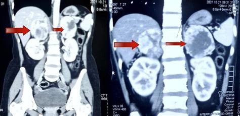 Ct Abdomen And Pelvis Showing Bilateral Adrenal Masses Download
