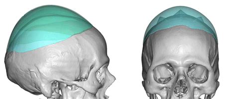 Plastic Surgery Case Study Male Custom Skull Heightening Implant
