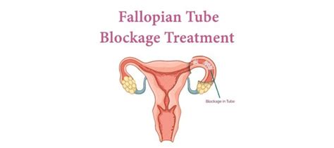 Treatment For Blocked Fallopian Tubes Symptoms And Fertility