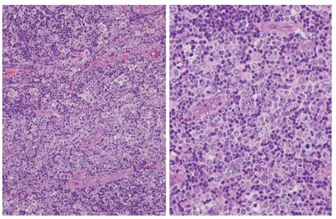 Angioimmunoblastic T Cell Lymphoma An Epstein Barr Virus Associated