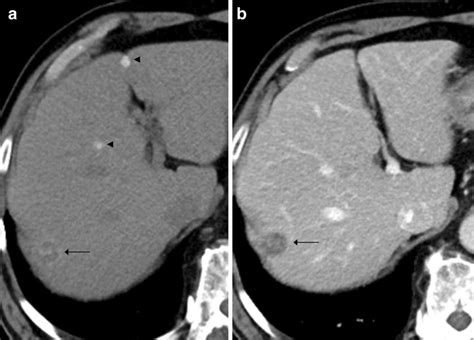 A B The Second Largest Hepatic Nodule Black Arrow With A Diameter Of