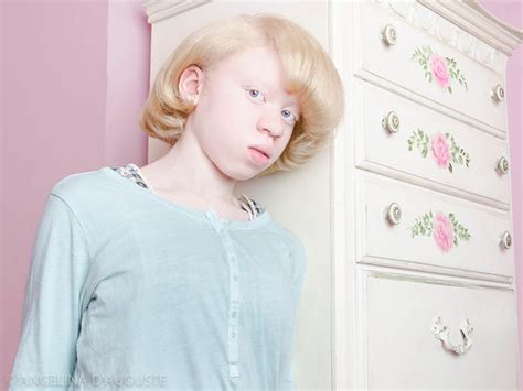 FIT Photographer Angelina D Auguste S Photo Series On Albinism