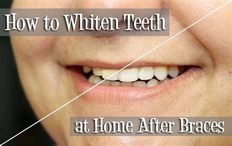 How To Whiten Teeth At Home After Braces