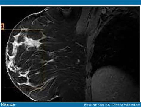 Sclerosing Adenosis Mimicking Malignant Lesion On Breast Mri
