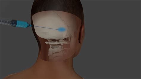 Treatment With Occipital Nerve Block Injections