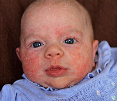 Eczema In Babies And Toddlers Wehavekids