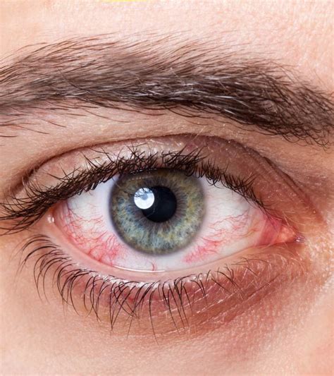 Natural Remedies For Red Eyes