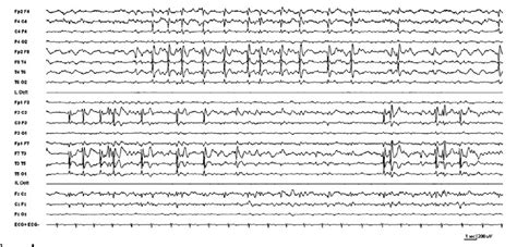 Benign Childhood Focal Epilepsies Semantic Scholar